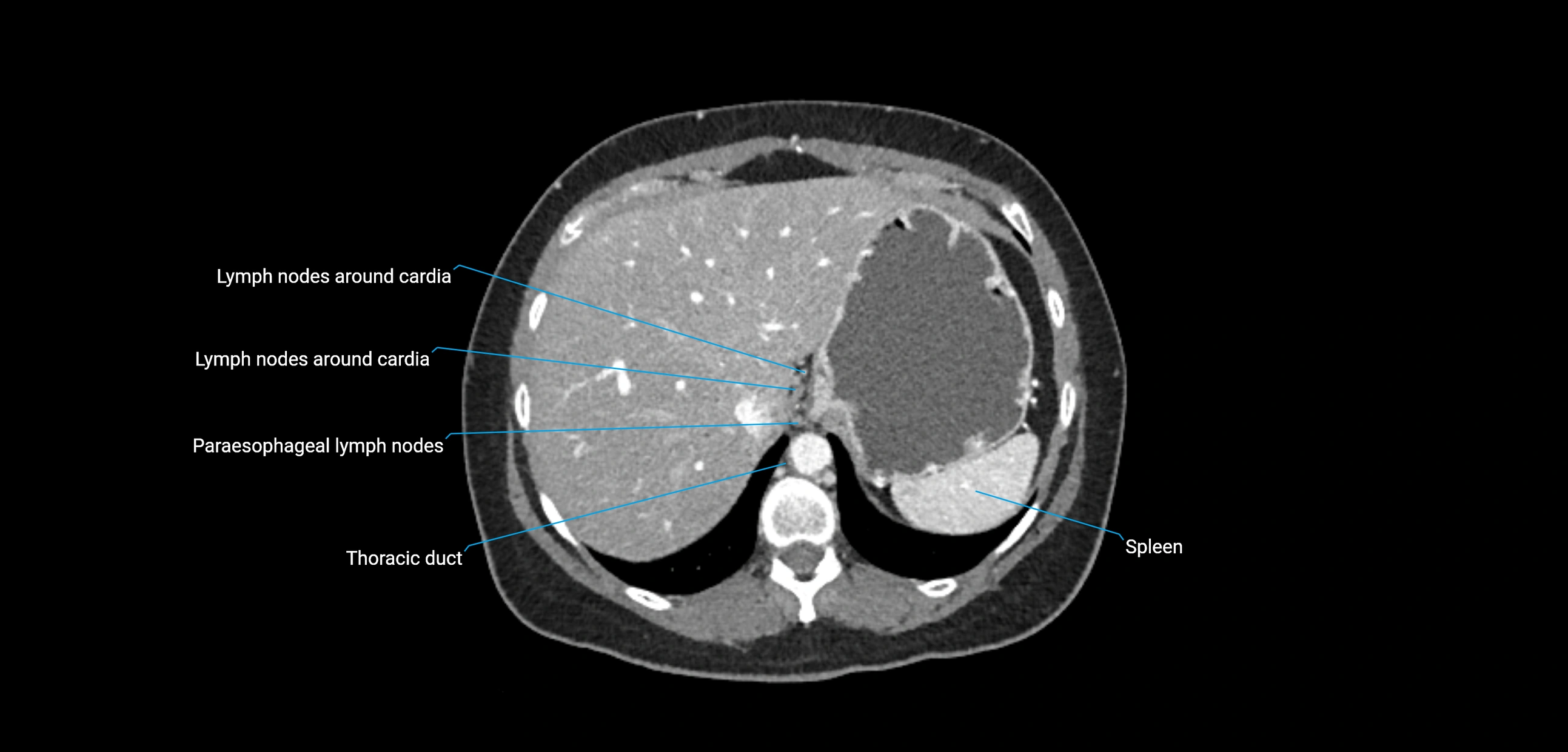 CT ct abdominal lymph nodes  axial cross sectional anatomy  enchanced radiology image -img-00002-00099.webp
